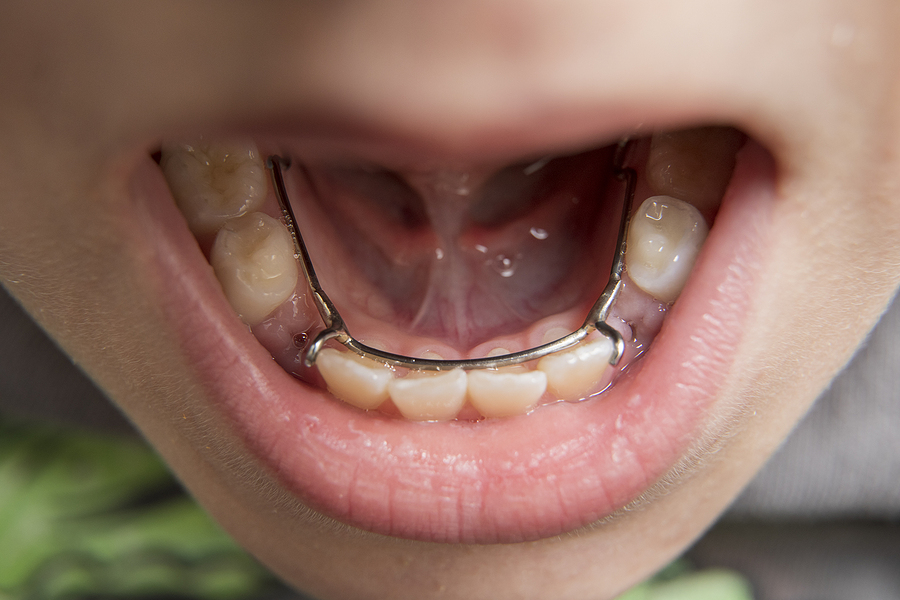 The Importance of Space Maintainers for Kids’ Dental Health in Tarzana, CA