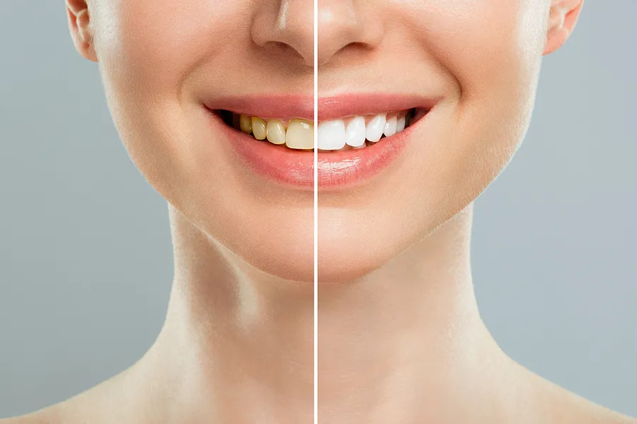 Brighten Your Smile Instantly: A Complete Guide to Zoom Teeth Whitening in Tarzana, CA